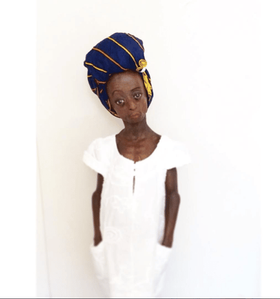 BEAUTIFUL ONTLAMETSE PHALATSE WAS BORN WITH A RARE AGE-ACCELERATING DISORDER BUT HER POSITIVITY IS CONTAGIOUS