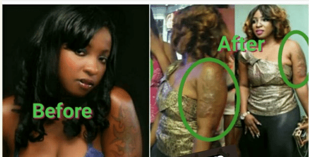 anita joseph before and after removal of tattoo