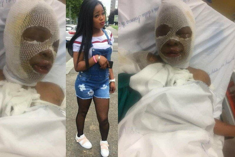 Nigerian lady pours acid on her fellow Nigerian lady in Italy (Photos)