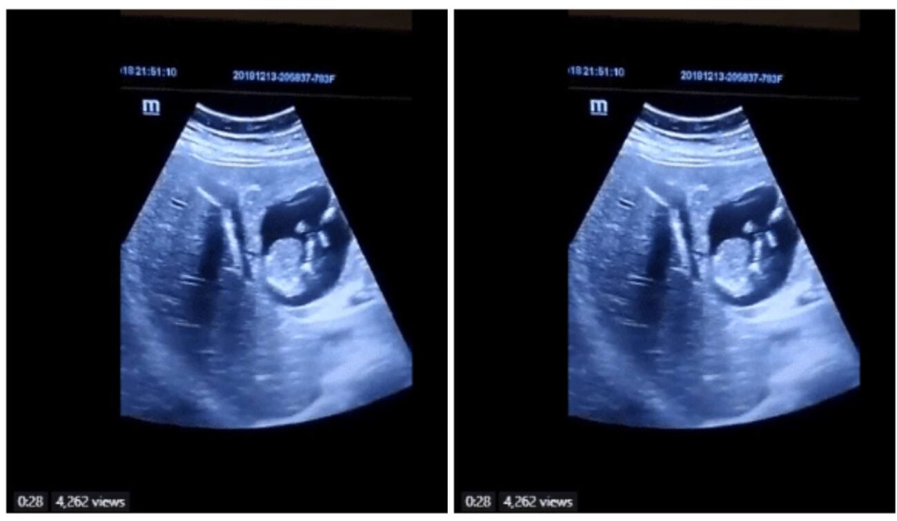 sonogram video shows baby growing in the liver