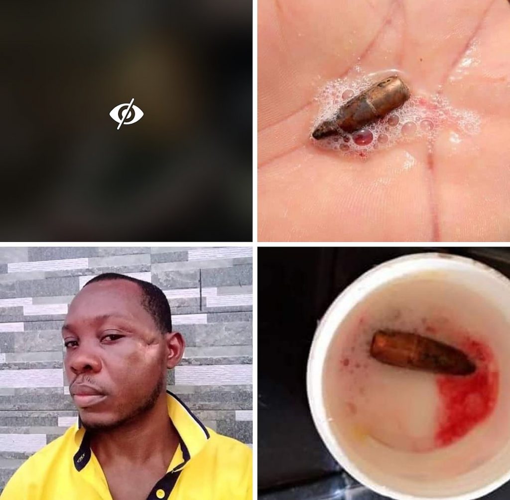 Nigerian man with bullet in his head