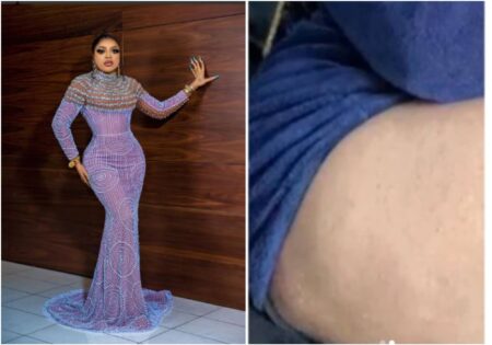 Bobrisky's big lap with rashes covering his yansh causes a stir on social media