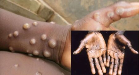 Monkeypox in Abia State